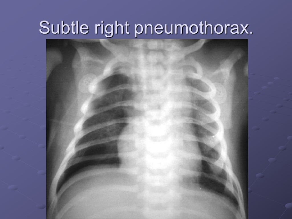 Subtle right pneumothorax.